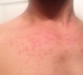 Rash allegedly incurred at NuHart Plastics Factory last week