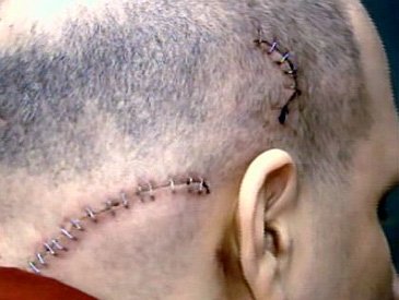 Joseph Lozito's injuries on his head