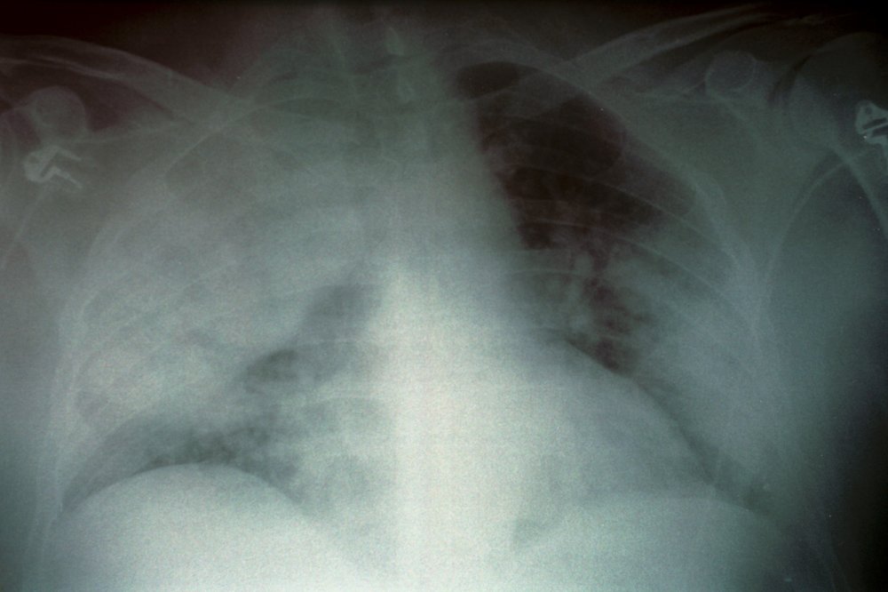 Lungs infected with the bacteria that causes Legionnaires' disease.