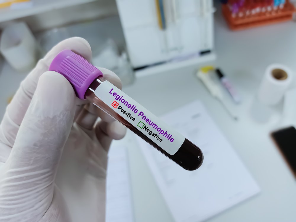 A scientist holds a blood sample that indicates the presence of the bacteria that causes Legionnaires' disease.