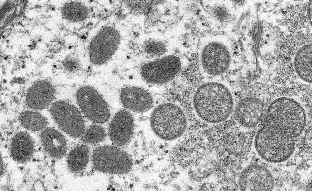 Electron microscopic (EM) image depicts a monkeypox virion, obtained from a clinical sample associated with the 2003 prairie dog outbreak.