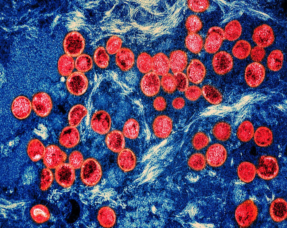 Colorized transmission electron micrograph of monkeypox virus particles (red) found within an infected cell (blue), cultured in the laboratory.