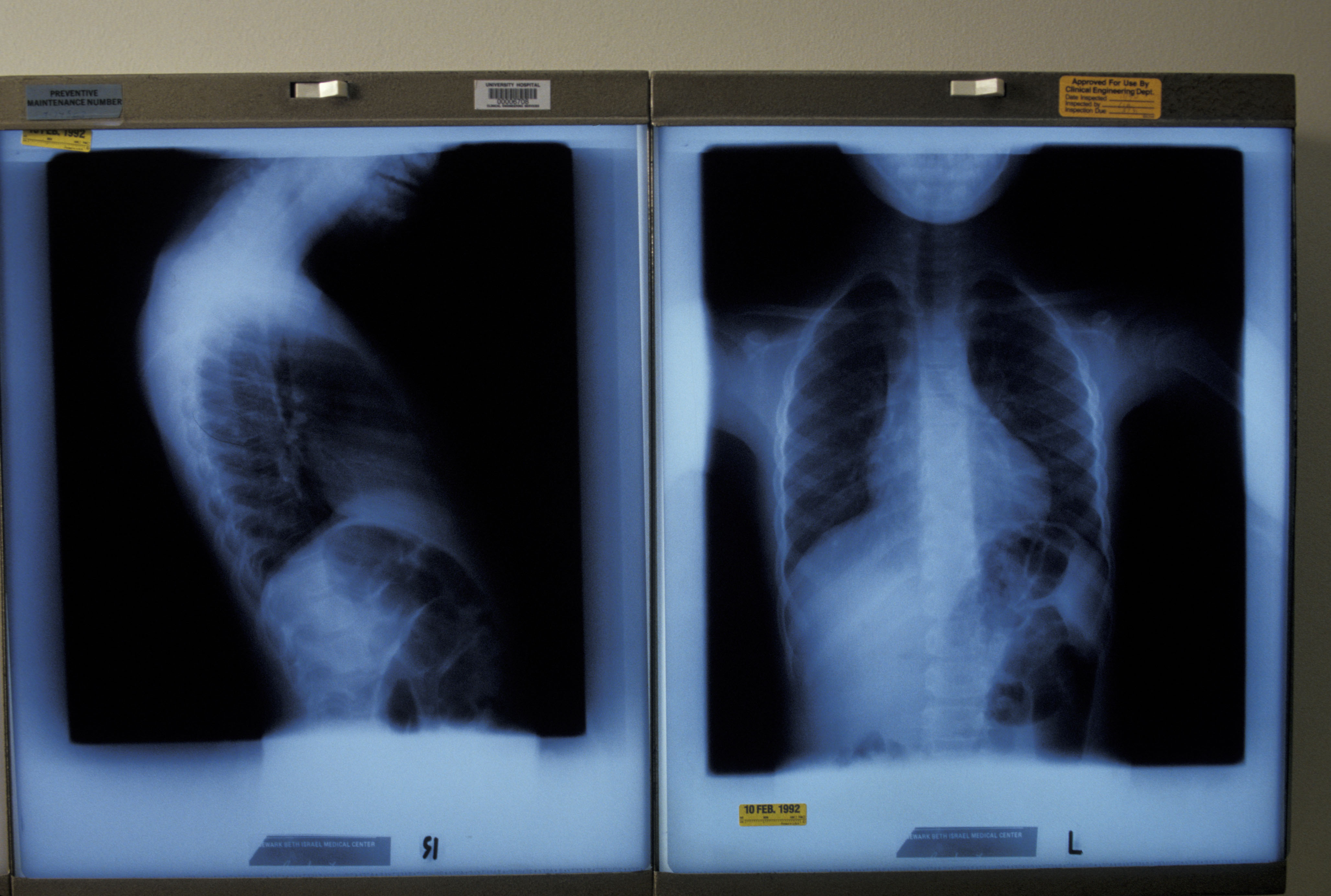NJ high school student tests positive for tuberculosis